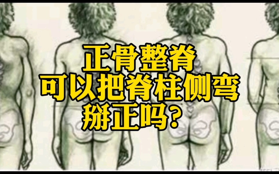 正骨整脊能不能把“脊柱侧弯”推正?哔哩哔哩bilibili