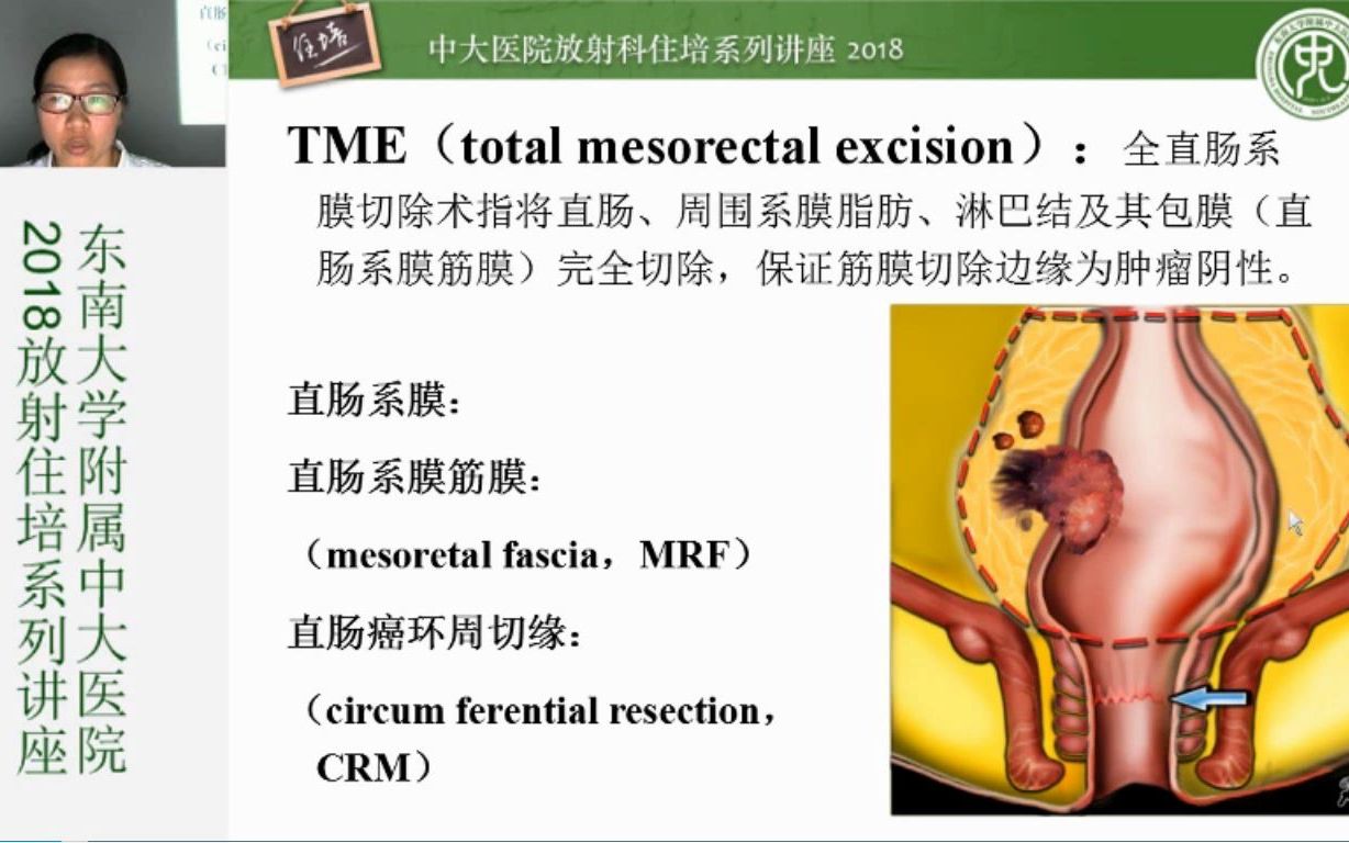 直肠癌MRI分期及报告中大王亚玲哔哩哔哩bilibili