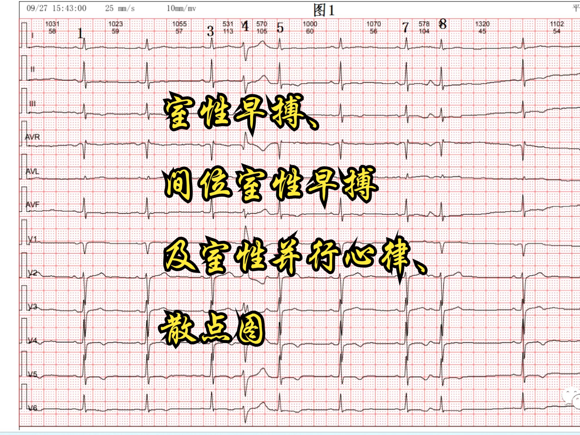室性早搏心电图特点图片