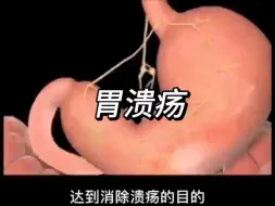 Download Video: 胃溃疡的原因你知道有哪些吗？