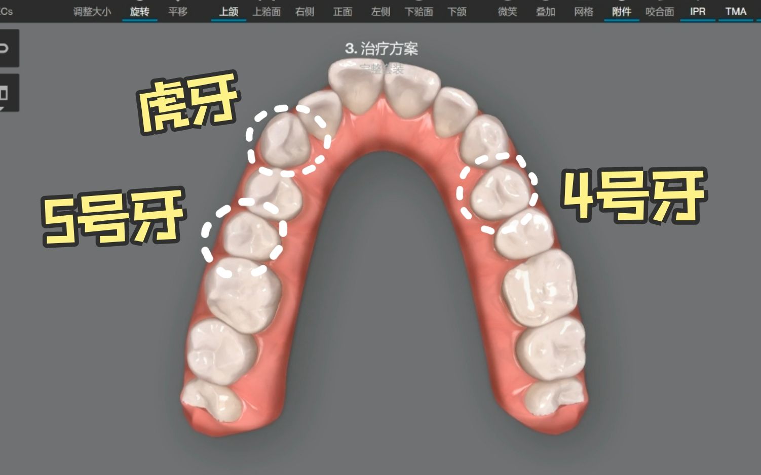 [图]拔牙矫正，一般选择拔哪颗？拔4号牙或5号牙有什么区别？