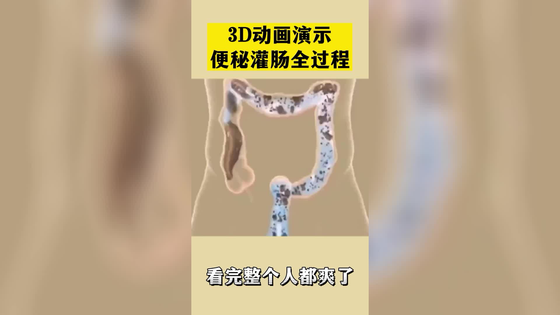 3D动画:便秘灌肠全过程哔哩哔哩bilibili