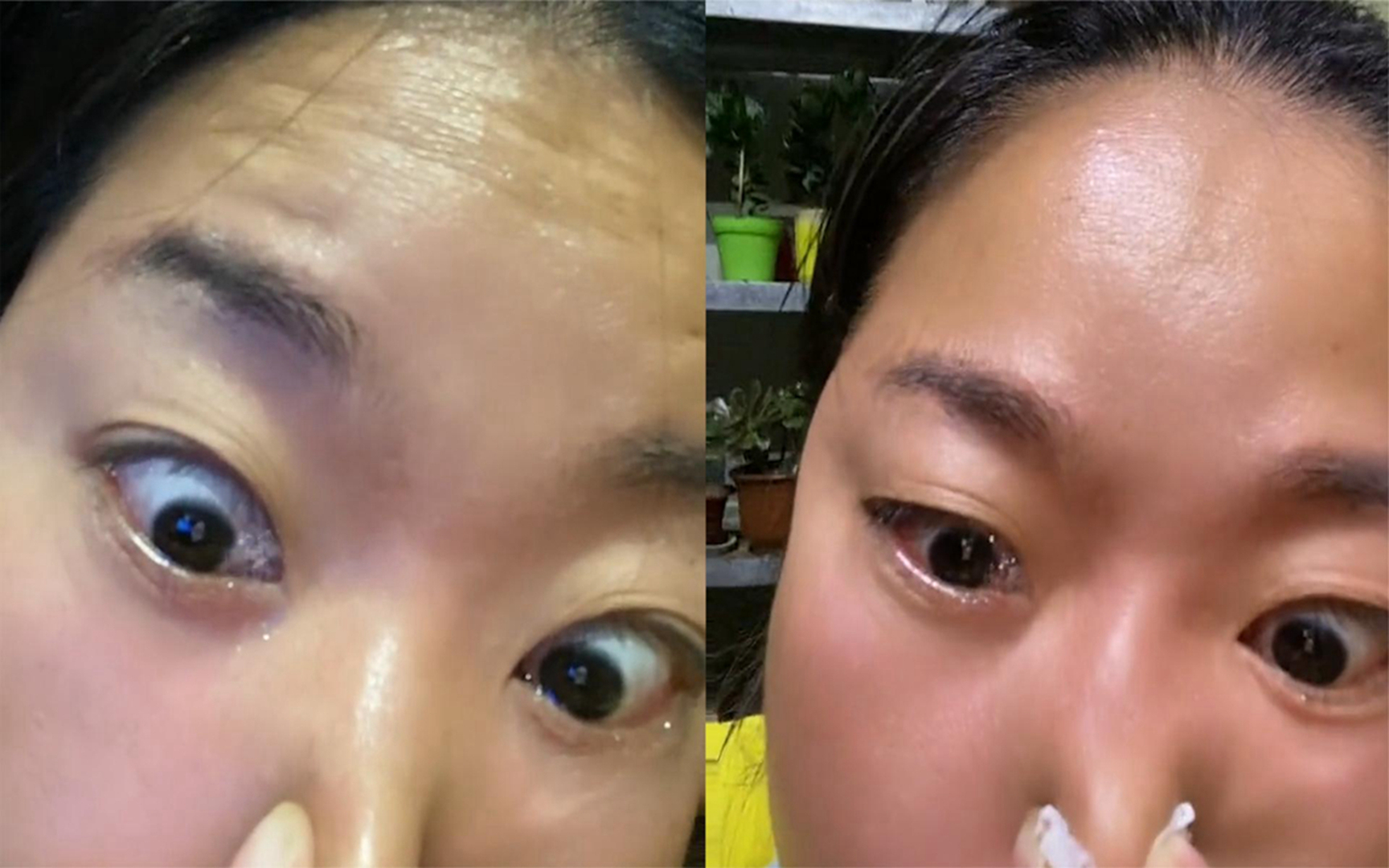 女子犯鼻炎后捏住鼻子使劲,下一秒眼角疯狂冒泡还流水:什么原理