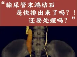 Download Video: 输尿管末端结石是快排出来了吗？！还需要处理吗？