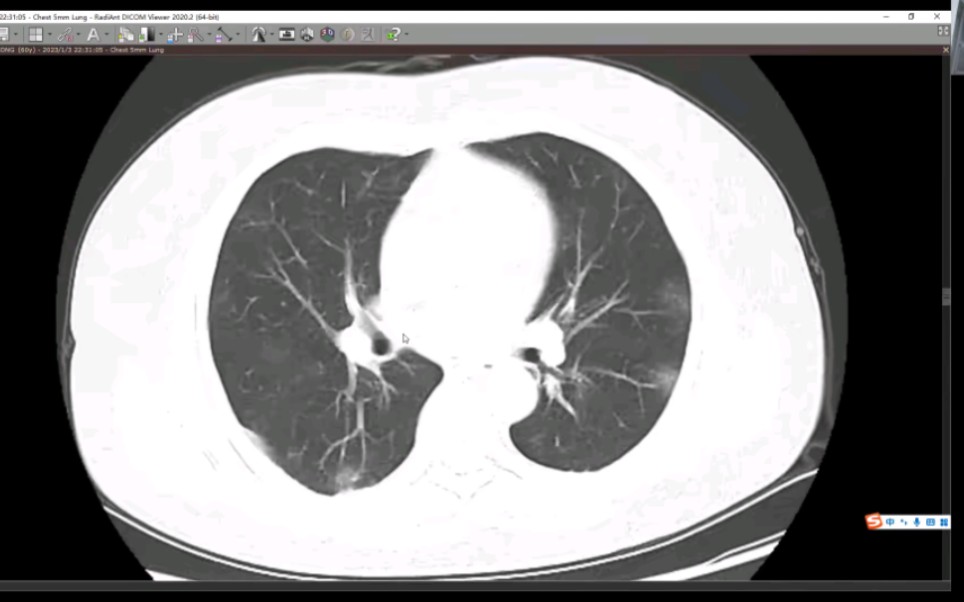 新冠肺炎CT哔哩哔哩bilibili
