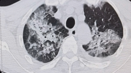 一例肺炎患者胸部ct前后对比哔哩哔哩bilibili