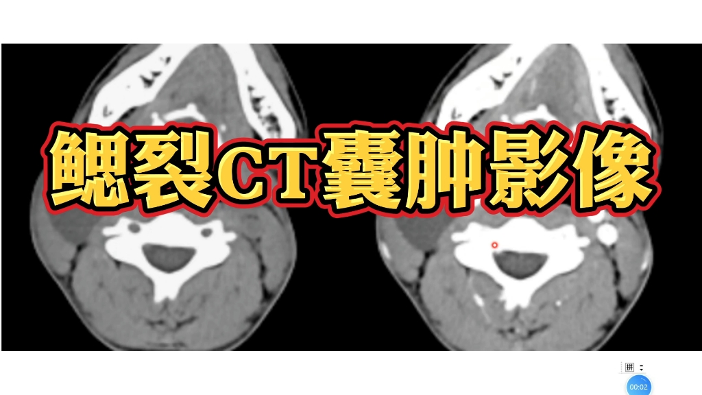 鳃裂囊肿典型CT表现分享,专科医生讲解!哔哩哔哩bilibili