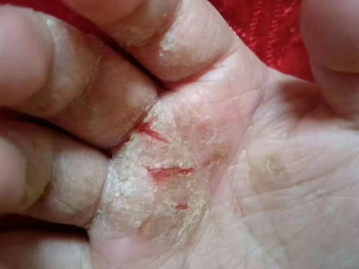 耗时3个月,成功根治手掌爆皮开裂,详细整理的治愈步骤大公开!