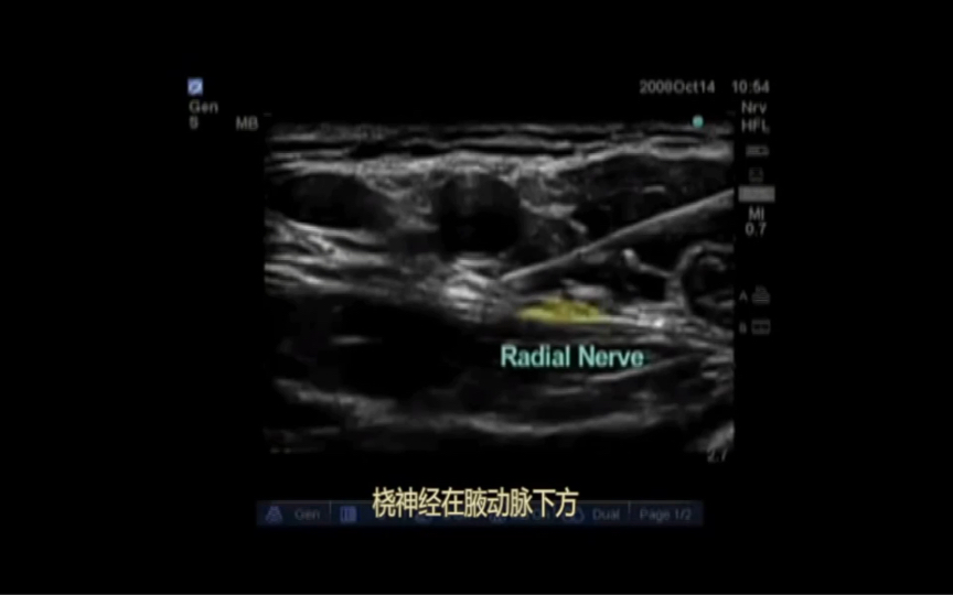 dr. auyong演示超声引导腋路臂丛神经阻滞