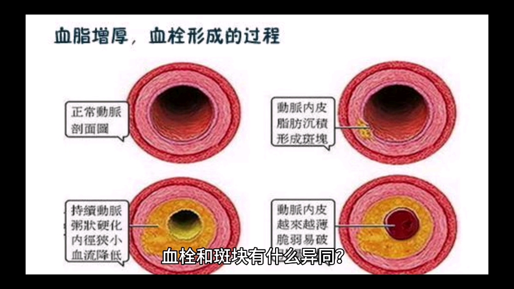 血栓和斑块有什么异同?