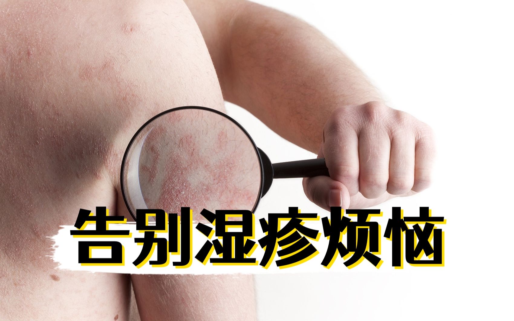 受湿疹折磨?这些技巧可以帮助你缓解痛苦!