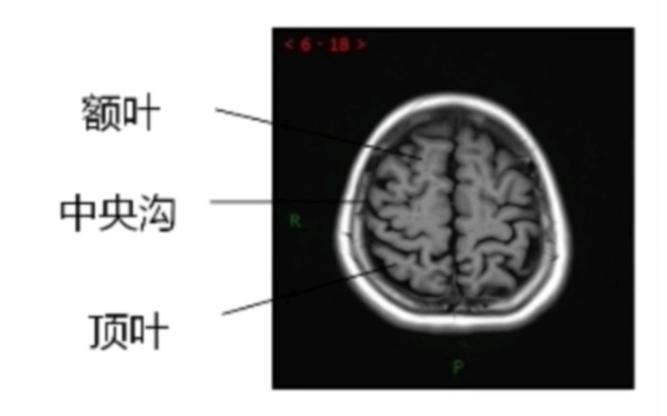 [图]颅脑MRI断层解剖讲解。