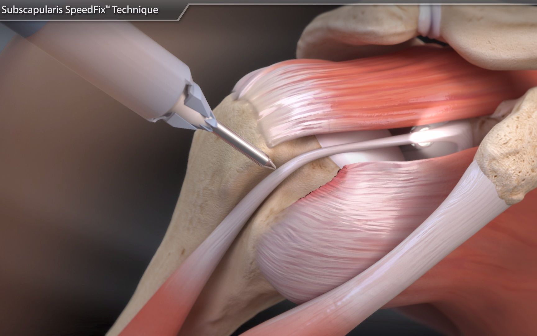Arthrex肩胛下肌SpeedFix无结技术用于修复肩胛下肌肌腱的小结节撕裂哔哩哔哩bilibili