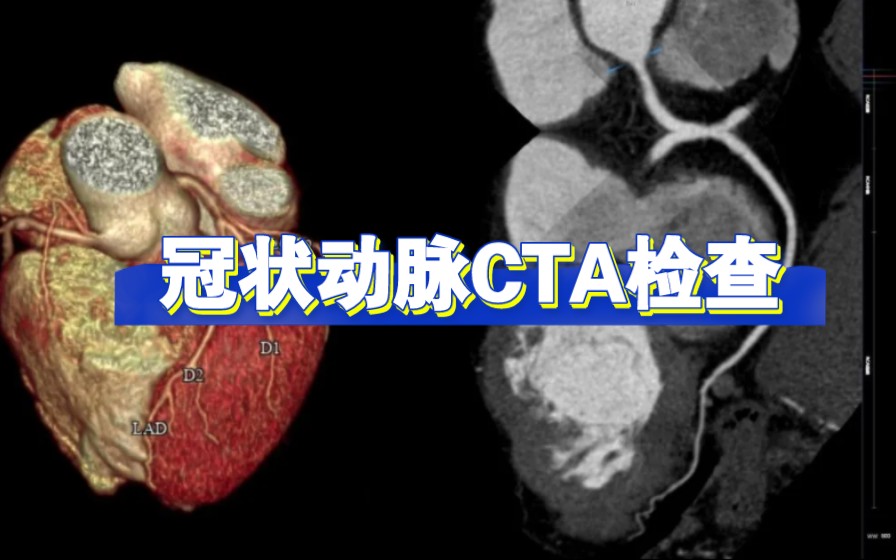 GE 64排CT“冠状动脉CTA扫描”直播课程操作讲解哔哩哔哩bilibili