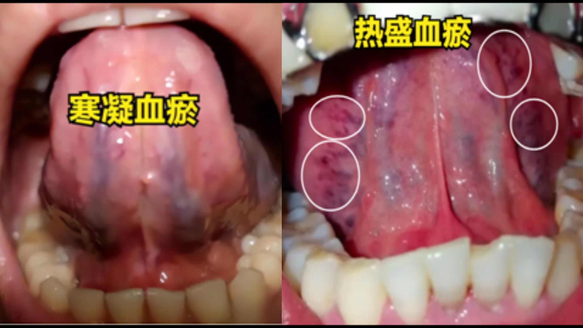 舌底青筋正常图片图片