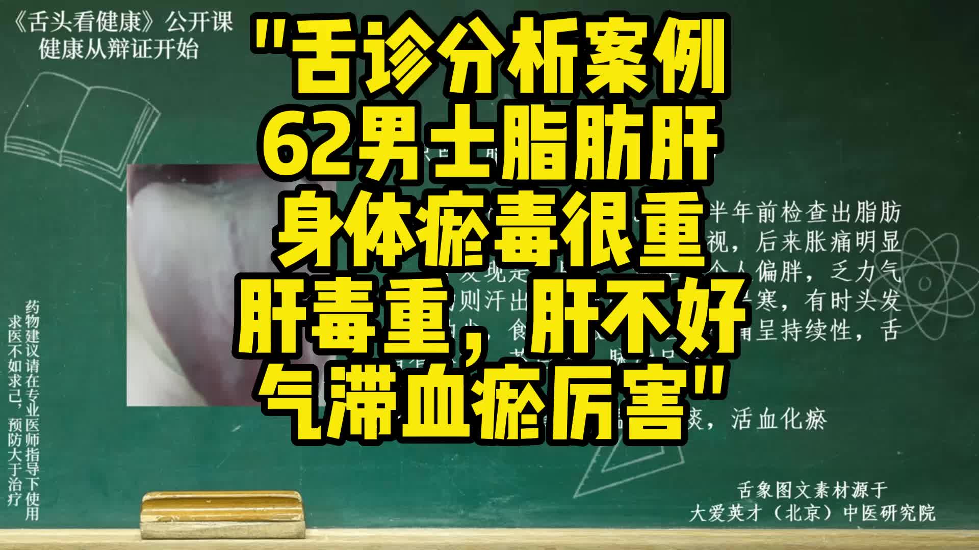 舌诊分析:脂肪肝,身体瘀毒很重,肝毒重,气滞血瘀厉害哔哩哔哩bilibili