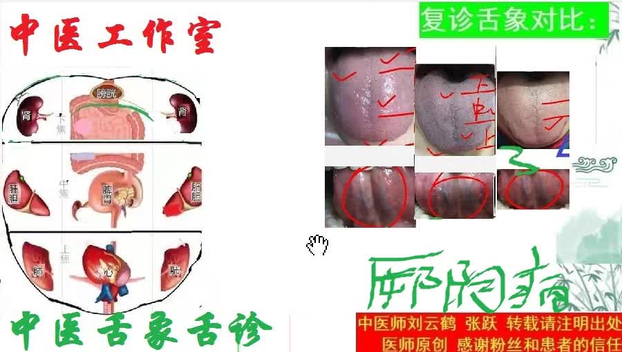 中医舌诊 肝郁血瘀舌象什么样 怎么调哔哩哔哩bilibili