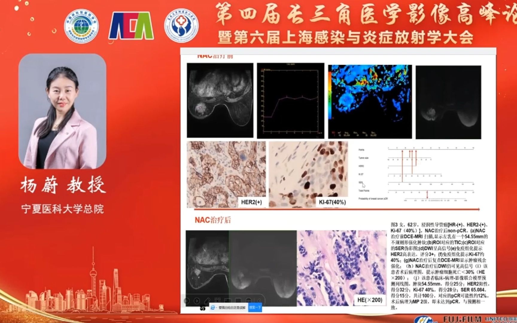 临床病理影像联合模型构建列线图预测乳腺癌新辅助治疗pCR杨蔚(宁夏医科大学总院)哔哩哔哩bilibili