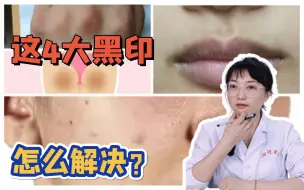 Tải video: 【科普】90％人都有的4大黑印，教你这样解决