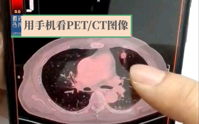 如何用手机看PET/CT图像哔哩哔哩bilibili