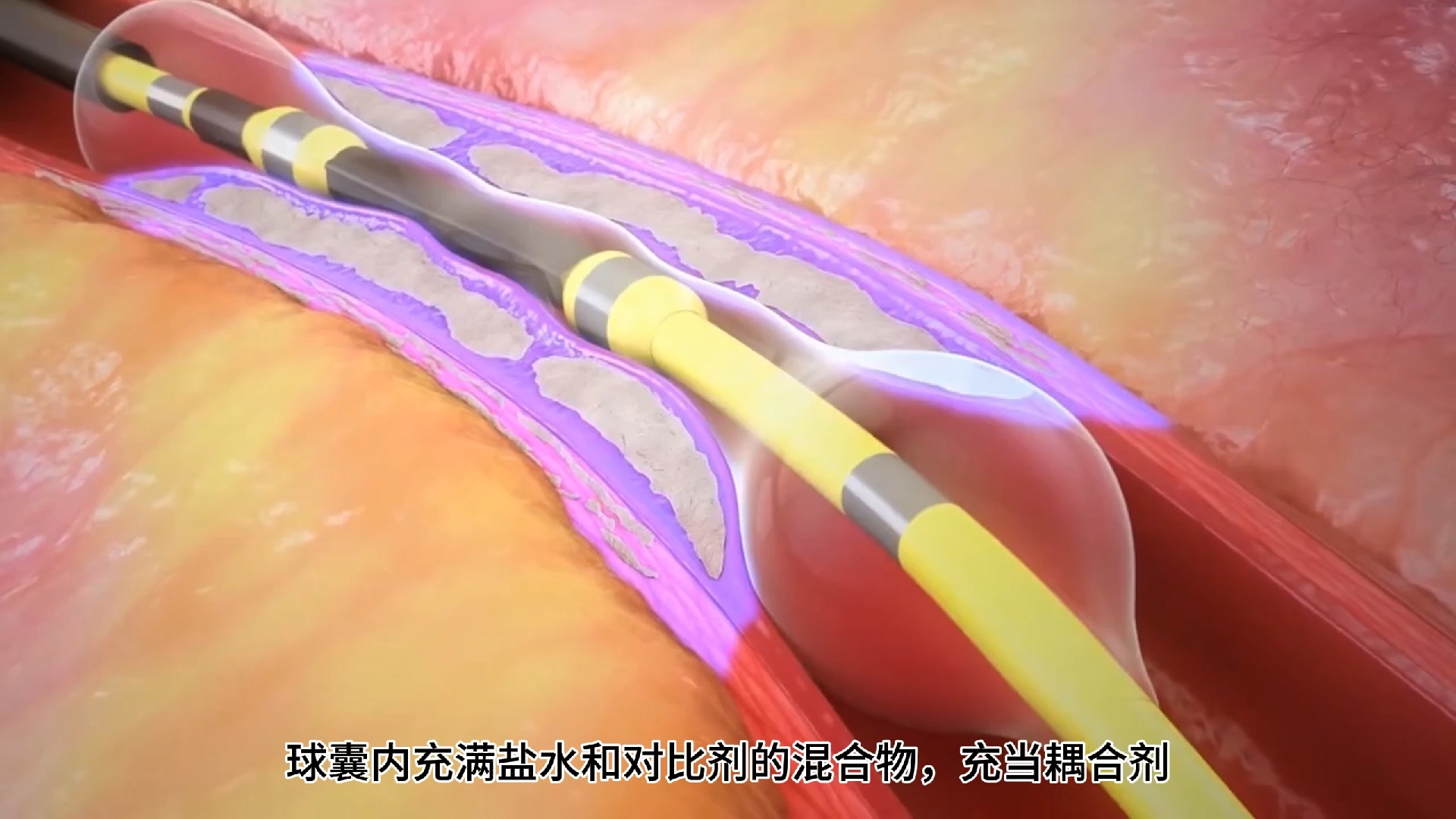 血管内冲击波碎石系统（IVL）
