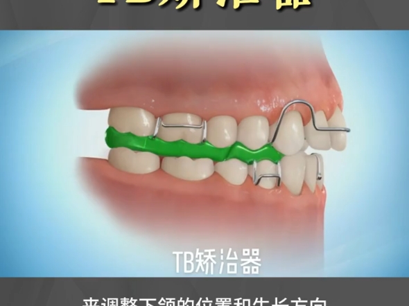 tb矫治器