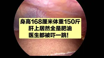 Download Video: 才150斤，肝里面居然全是肥油，减肥刻不容缓！