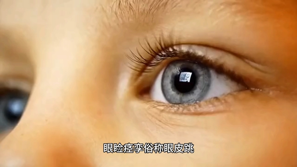 梅杰综合症之眼睑痉挛