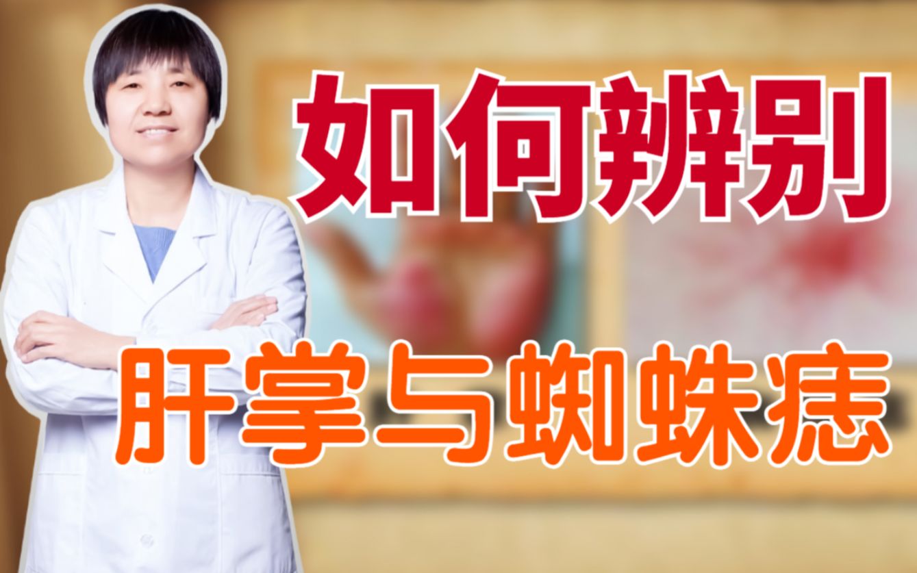 肝病患者长期手掌发红?注意了!可能是肝硬化的前期哔哩哔哩bilibili