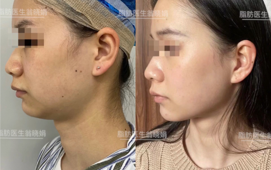 下颌缘吸脂术后20天对比