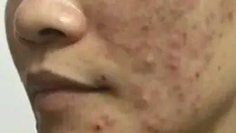 激素脸知识 色素沉着有黑斑怎么办 哔哩哔哩 Bilibili 激素脸知识 色素沉着有黑斑怎么办 哔哩哔哩 Bilibili