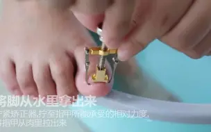 Descargar video: 甲沟炎矫正器使用方法