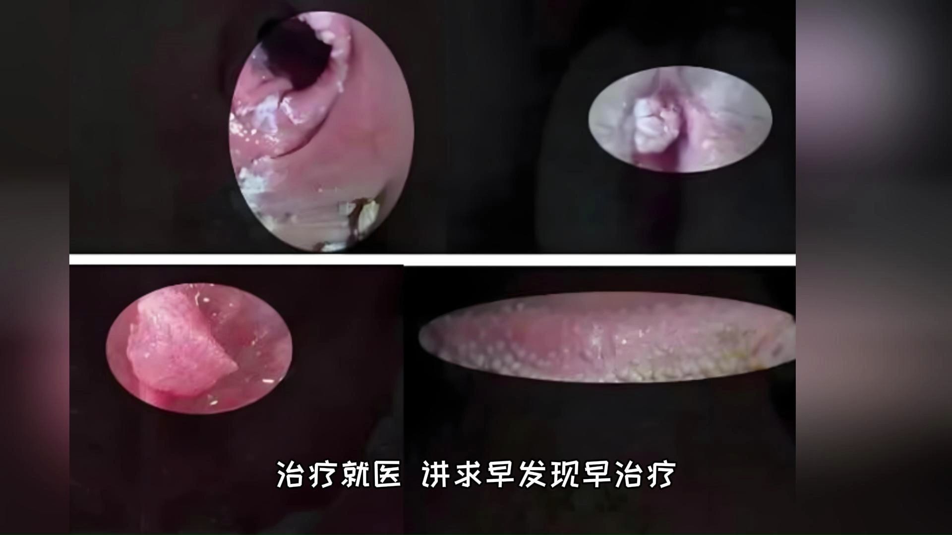 通过疣体状态判断尖锐湿疣所处时期,尖锐湿疣症状图片
