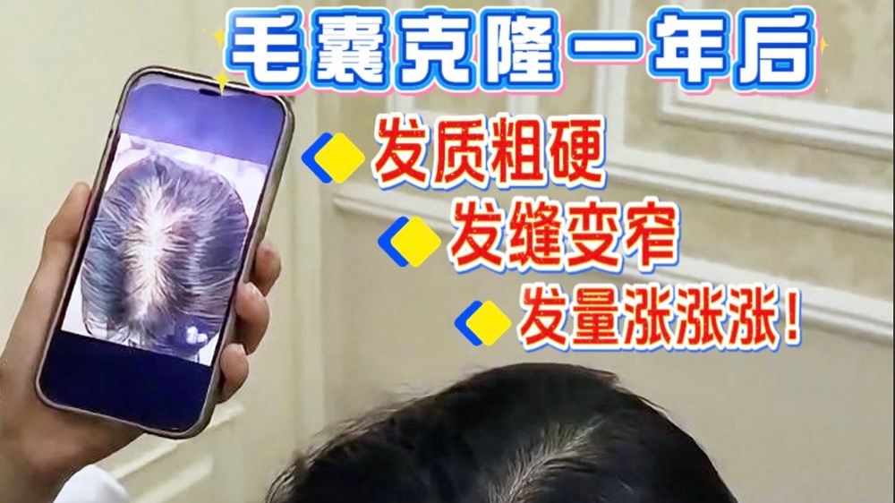 毛囊克隆发量涨涨涨