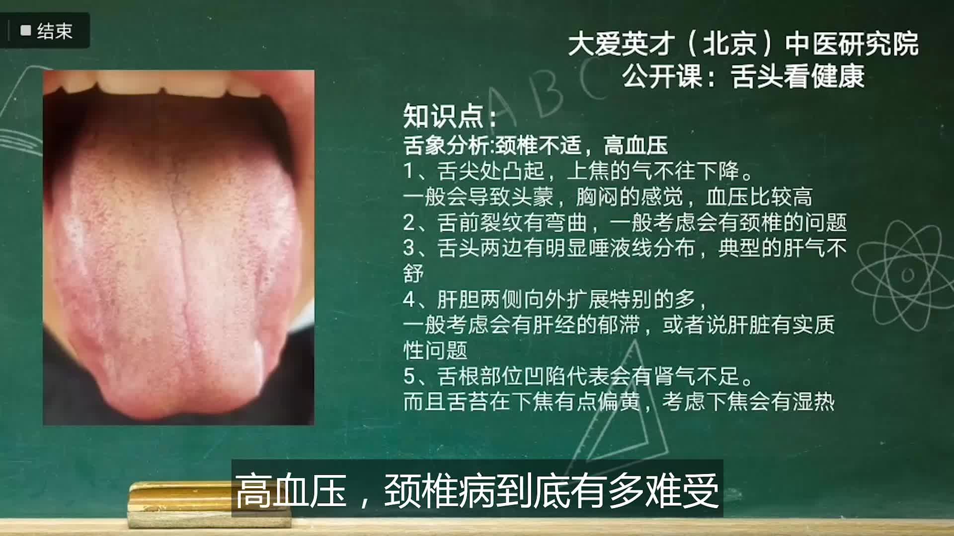 舌象分析:高血压,颈椎不适,胸闷头蒙的舌象讲解哔哩哔哩bilibili