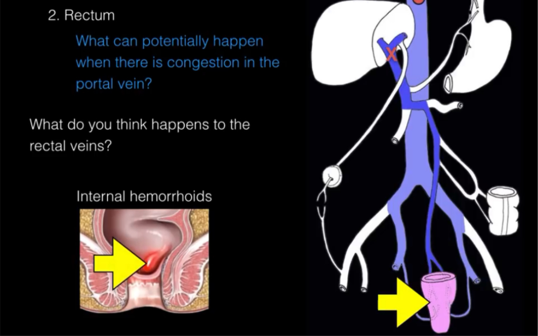 【消化系统解剖学】肝门静脉系统解剖 Hepatic Portal System|肝门静脉及其属支|肝门静脉系的交通|呕血、便血和脐周静脉曲张哔哩哔哩bilibili