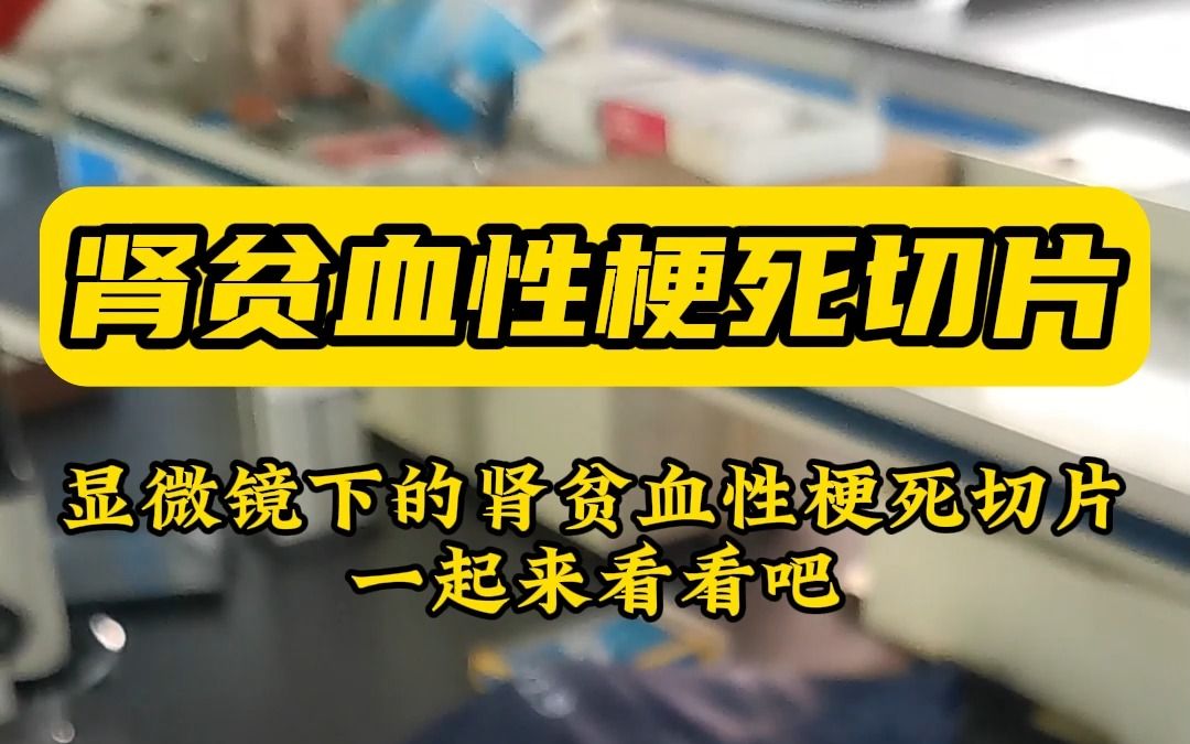 肾贫血性梗死切片