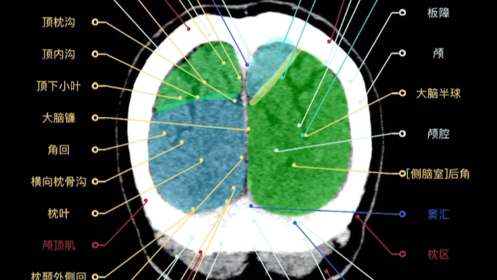 头部CT 解剖图哔哩哔哩bilibili
