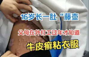 Video herunterladen: 女孩16岁长一肚“藤壶”？父母在外打工过年才知道，牛皮癣粘衣服