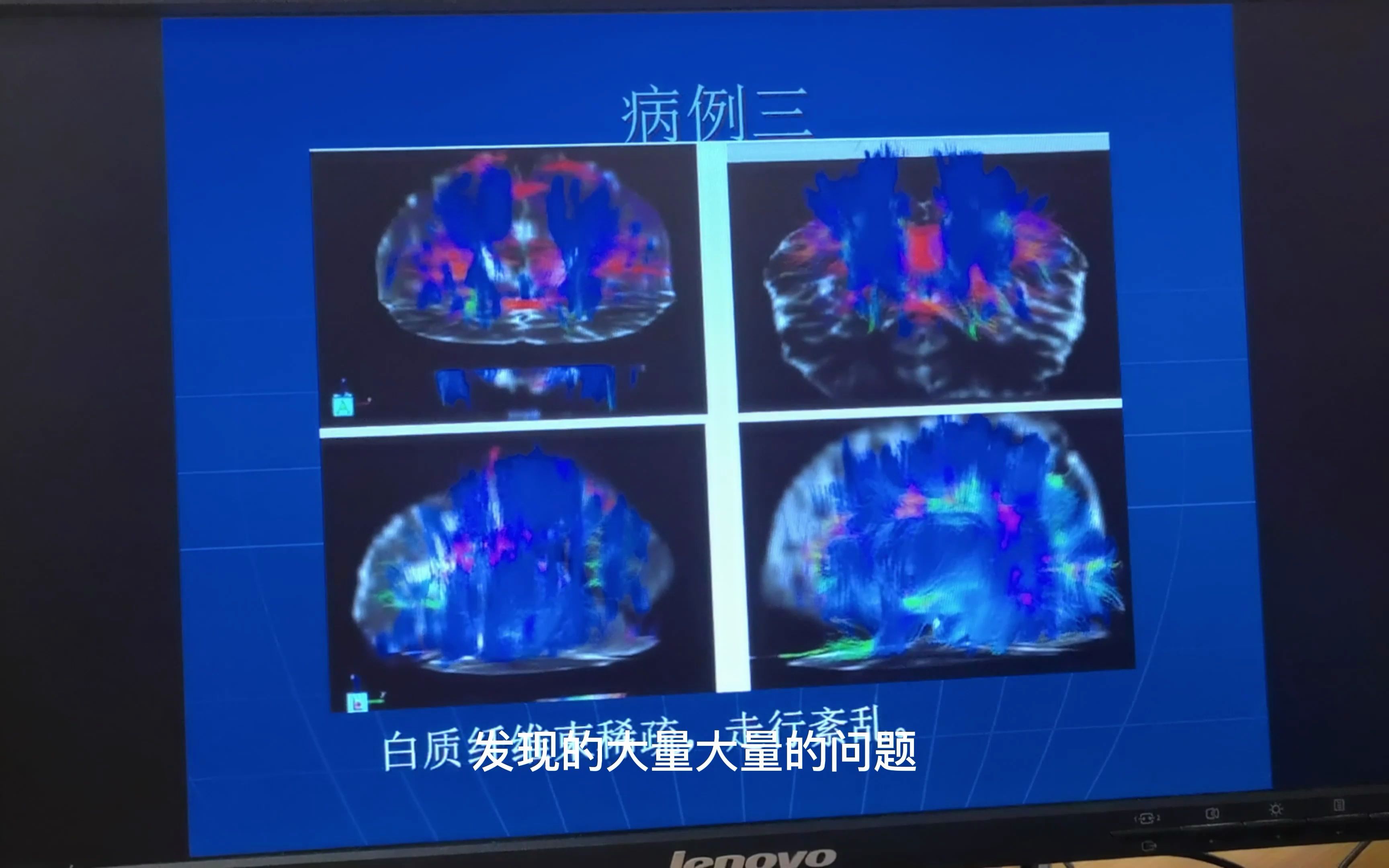 海南博鳌附属干细胞医院李彦文副院长解读小儿脑瘫(三)哔哩哔哩bilibili