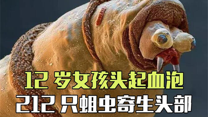 86岁老人耳朵生蛆,12岁女孩头顶生蛆,苍蝇为何把卵产在人脸上?