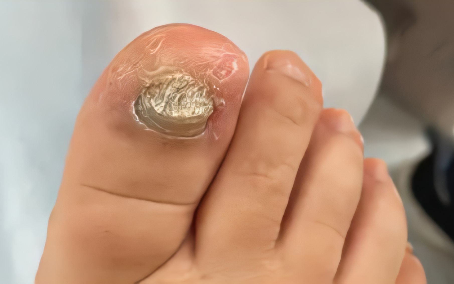 灰指甲泛黄增厚怎么办?康复者曝光自用秘籍!在家就能轻松抑菌!