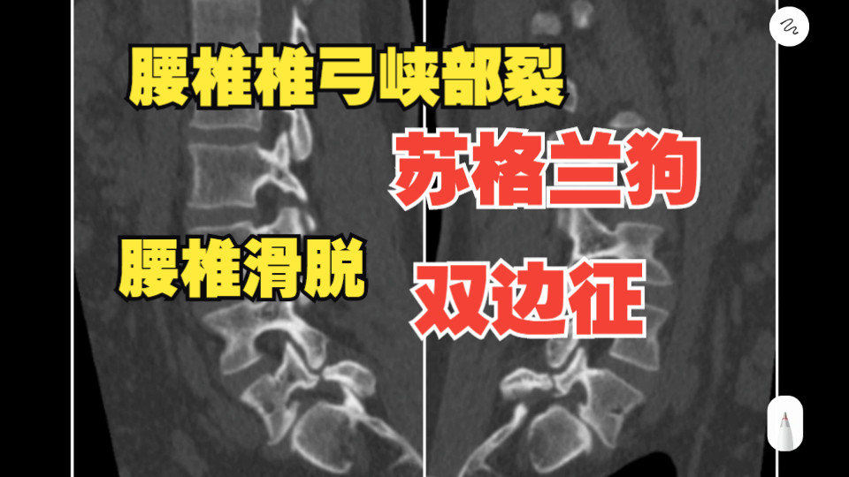 手把手教你看教科书式典型案例 腰椎椎弓峡部裂 腰椎滑脱