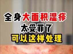 Download Video: 全身大面积湿疹 太受罪了 可以这样处理