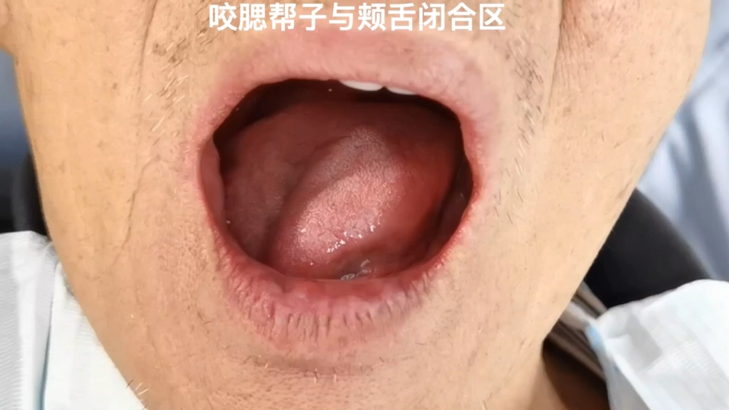 咬腮帮子的处理方法