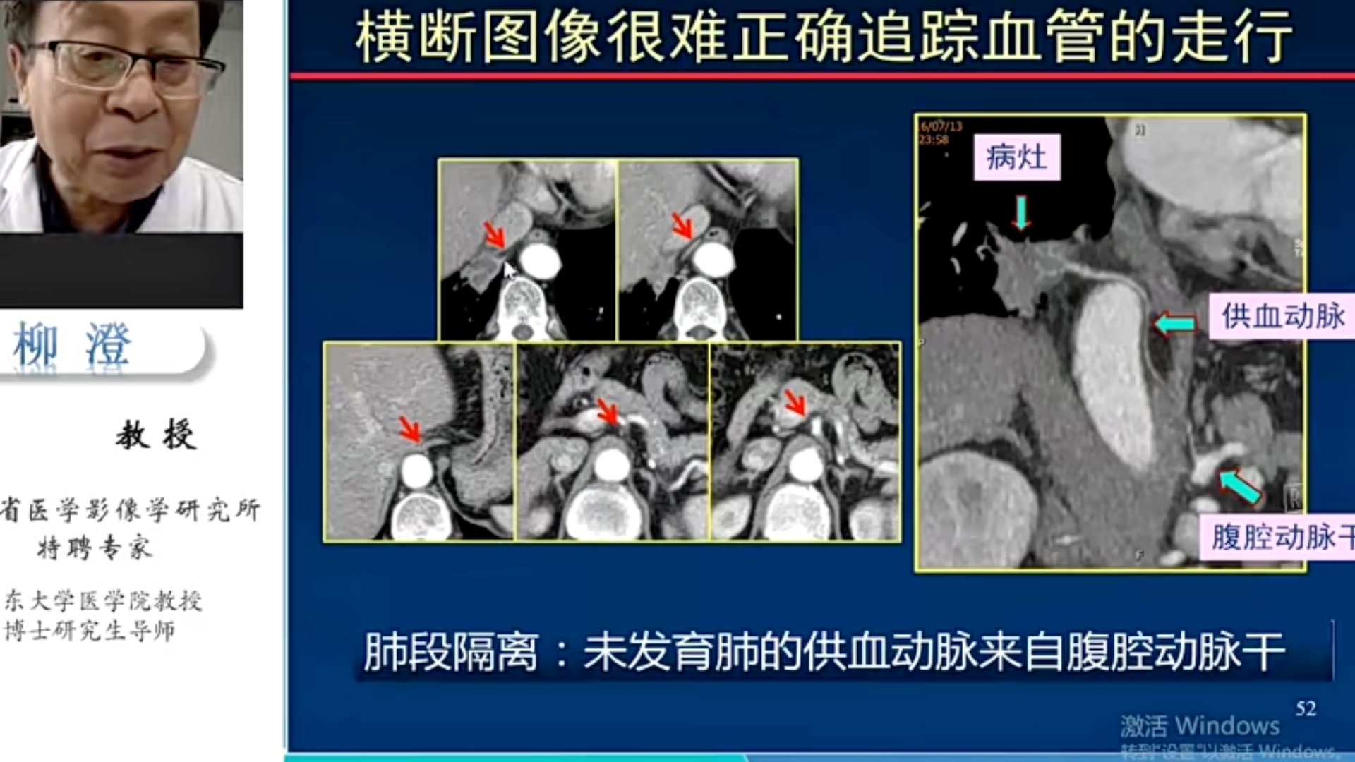 [图]肺内病变CT诊断基础（柳澄）：05正确判读肺间质改变的CT征象1