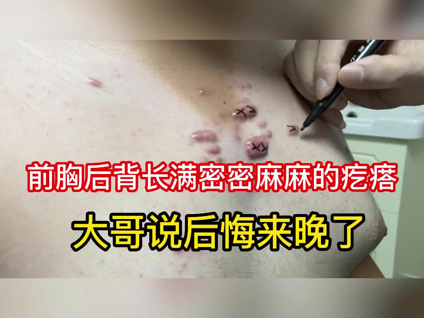 男子前胸后背长满密密麻麻的疤痕疙瘩,医生画出要切除的部分哔哩哔哩bilibili