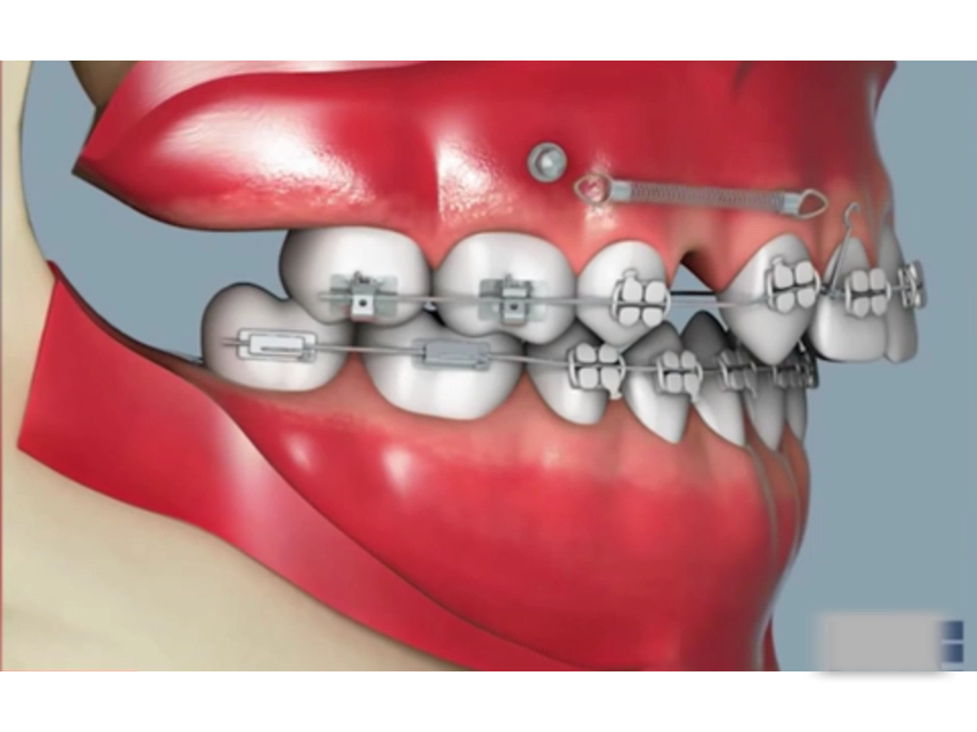 常见牙齿畸形矫正方法3D动画演示哔哩哔哩bilibili