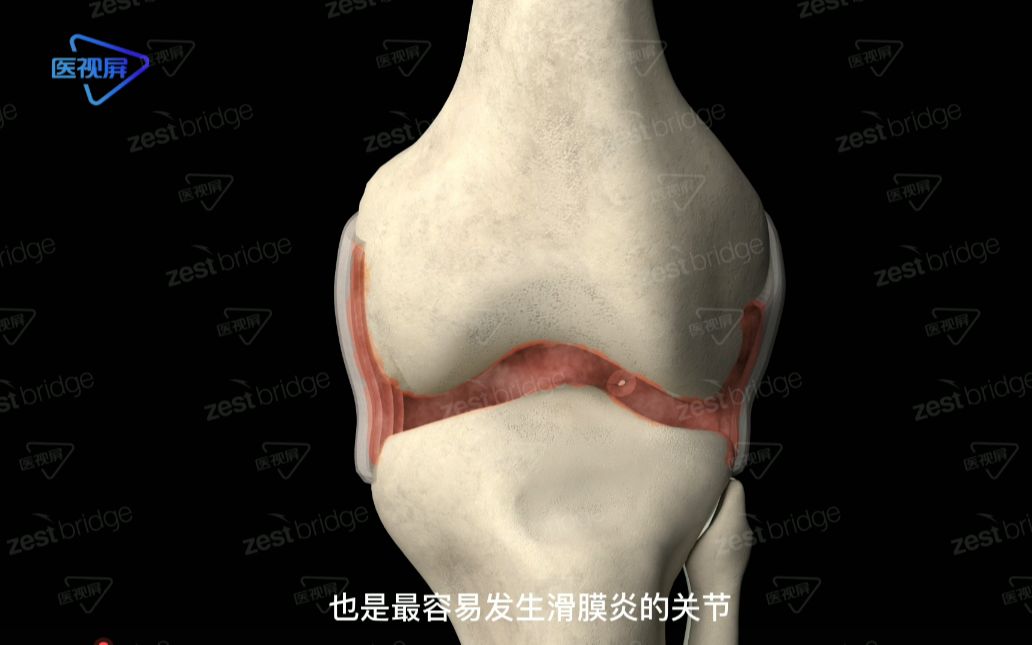 【医学3D】:膝关节滑膜炎哔哩哔哩bilibili