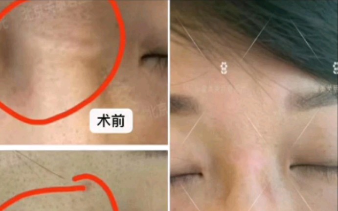 鼻梁凹陷性疤痕这是小时候外伤后形成的凹陷性疤痕这种co2激光治疗是